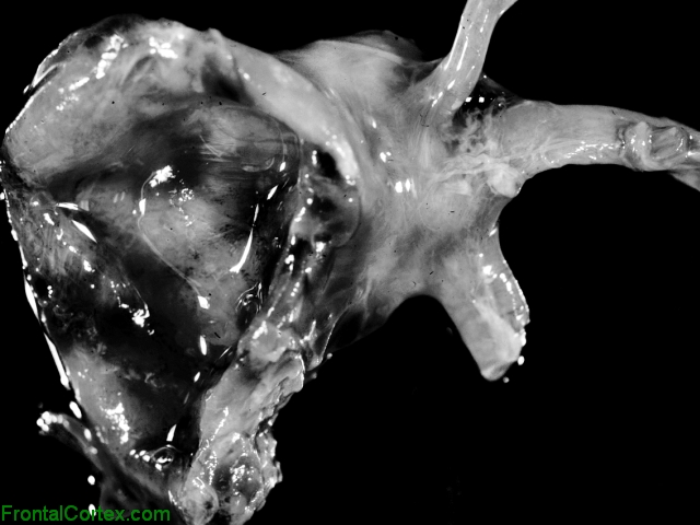 Ruptured MCA aneurysm, dissected